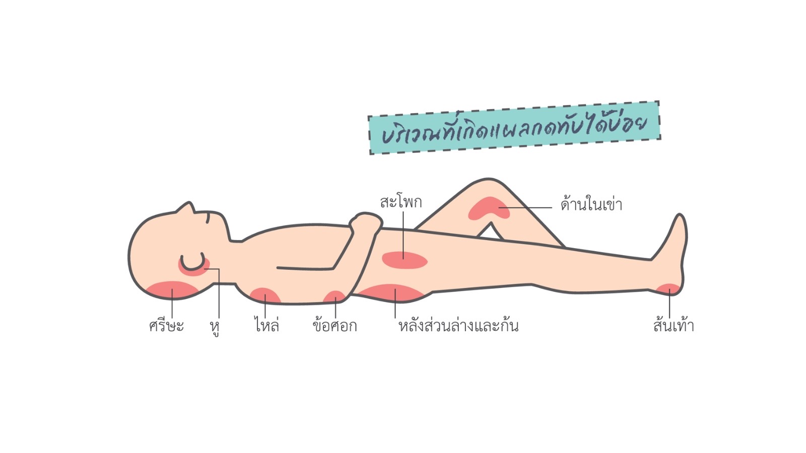 อุปกรณ์การดูแลแผลกดทับ