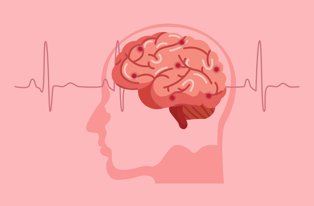 สมองเสื่อมจากหลอดเลือดสมอง